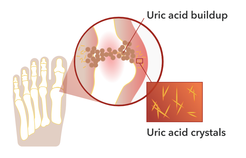 Diagram showing uric acid buildup and uric acid crystals near the big toe.