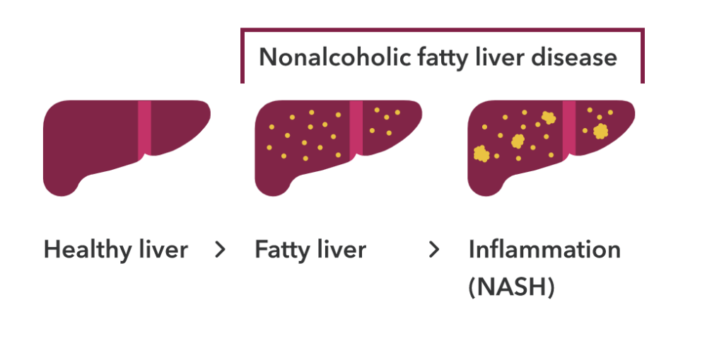 A healthy liver compared to nonalcoholic fatty liver disease both in a fatty liver and a liver with inflammation (NASH). There are yellow spots in the fatty liver and larger yellow spots in the liver with inflammation. This is visual evidence of nonalcoholic fatty liver disease.&nbsp;