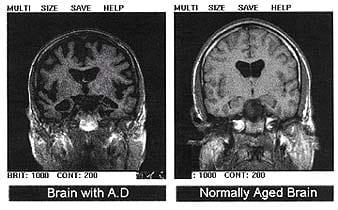Early Detection, Prediction, and Prevention of Alzheimer’s Disease