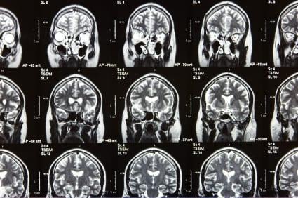 Genetic Associations with Brain Aneurysm