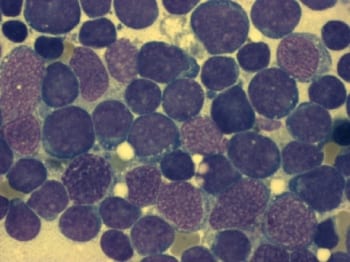 acutelymphoblasticleukemia