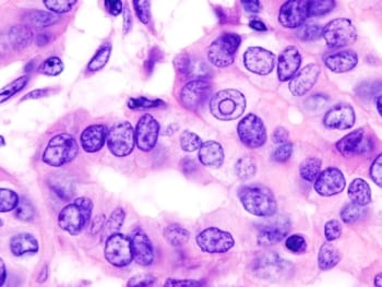 thyroid_papillary_carcinoma_histopathology_4