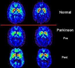 parkinsonsdisease