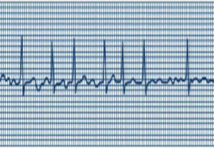 heartrhythm