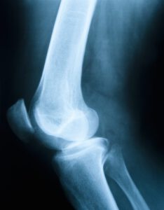 Bone x-ray